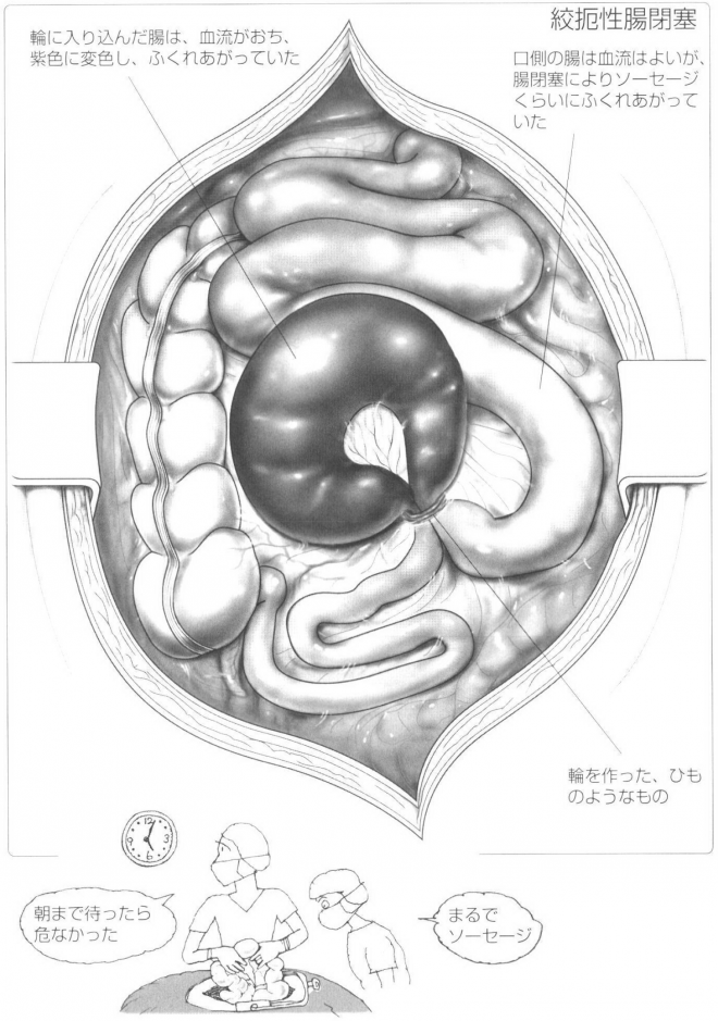 絞掘性腸閉塞