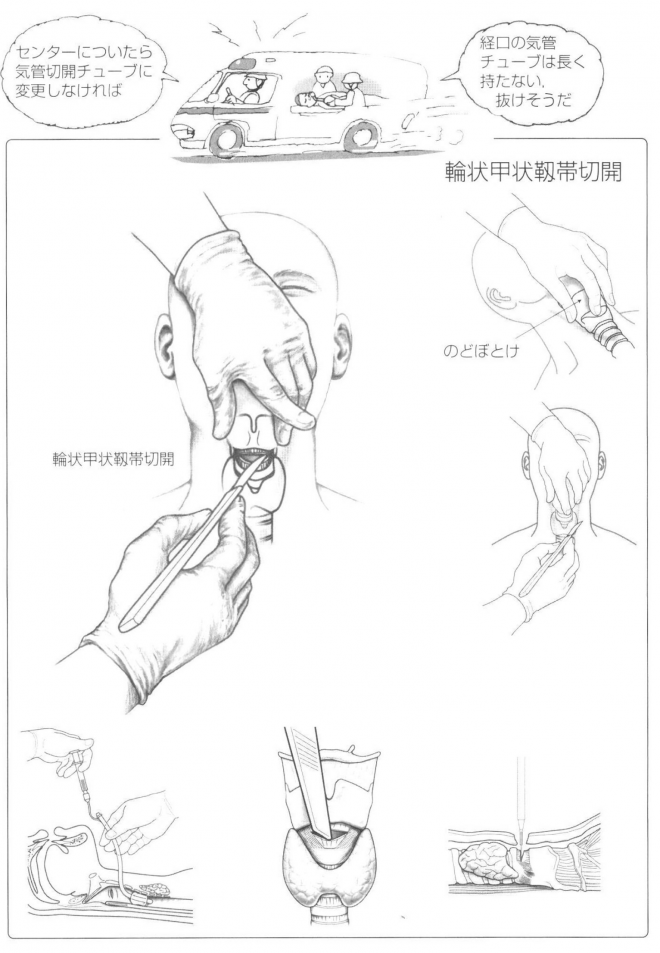 輪状甲状靭帯切開