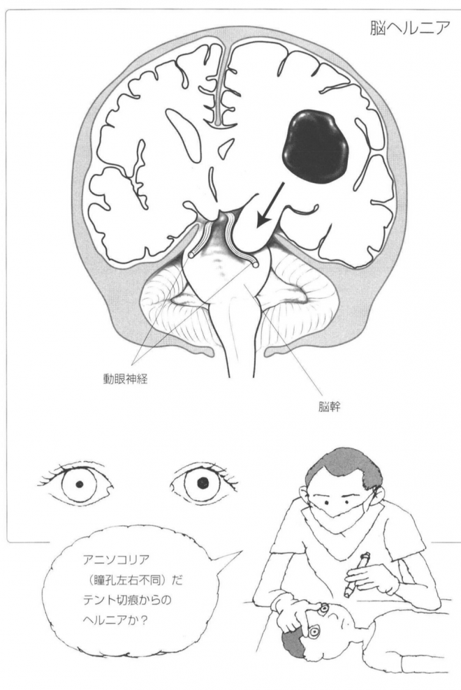 脳ヘルニア
