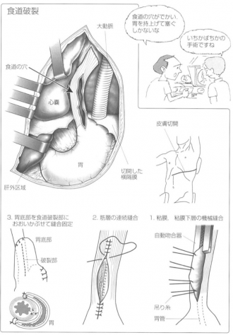 食道破裂
